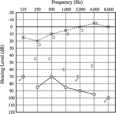 Congenital Membranous Stapes Footplate Producing Episodic Pressure-Induced Perilymphatic Fistula Symptoms